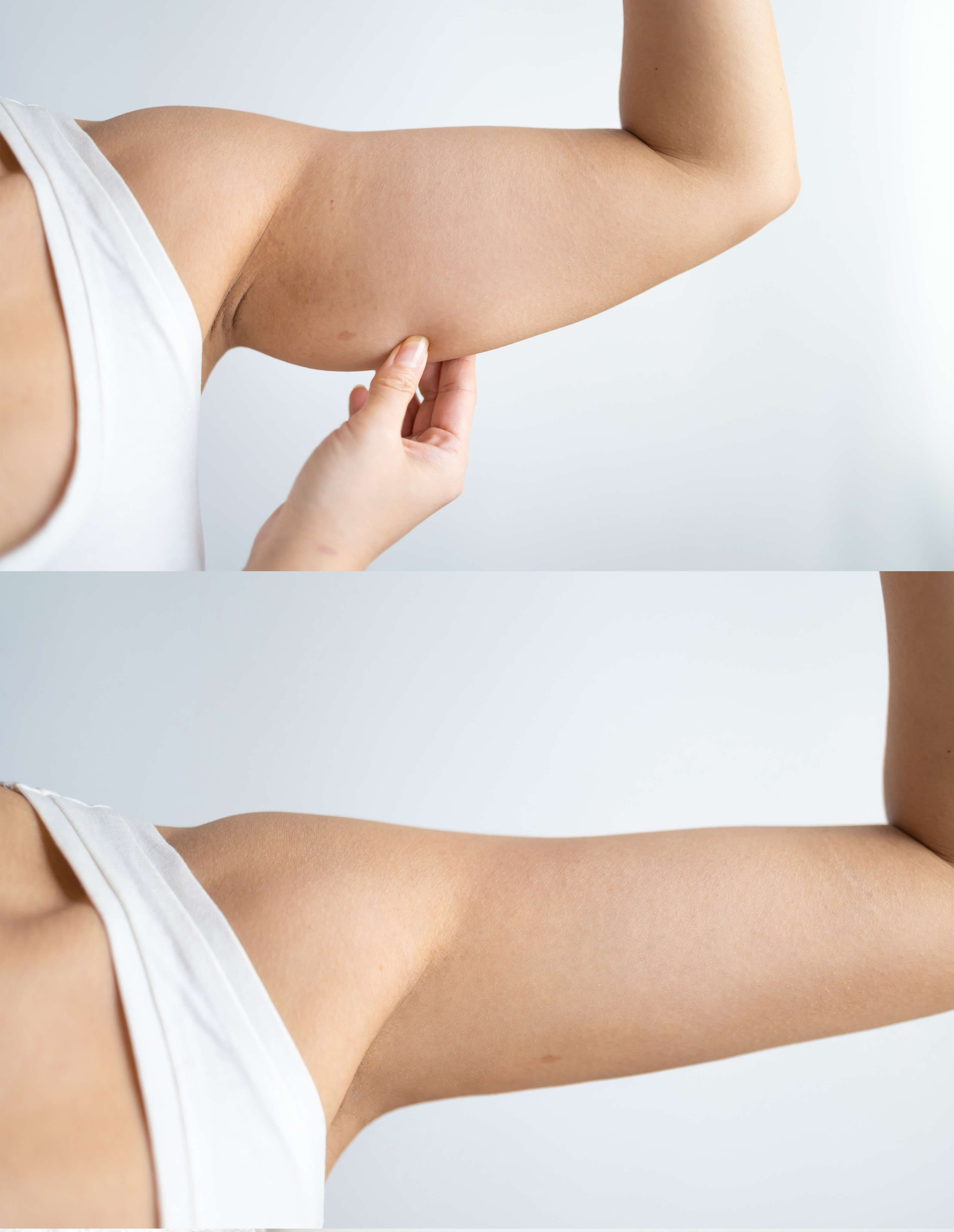 Arm Liposuction / Brachioplasty before and after result
