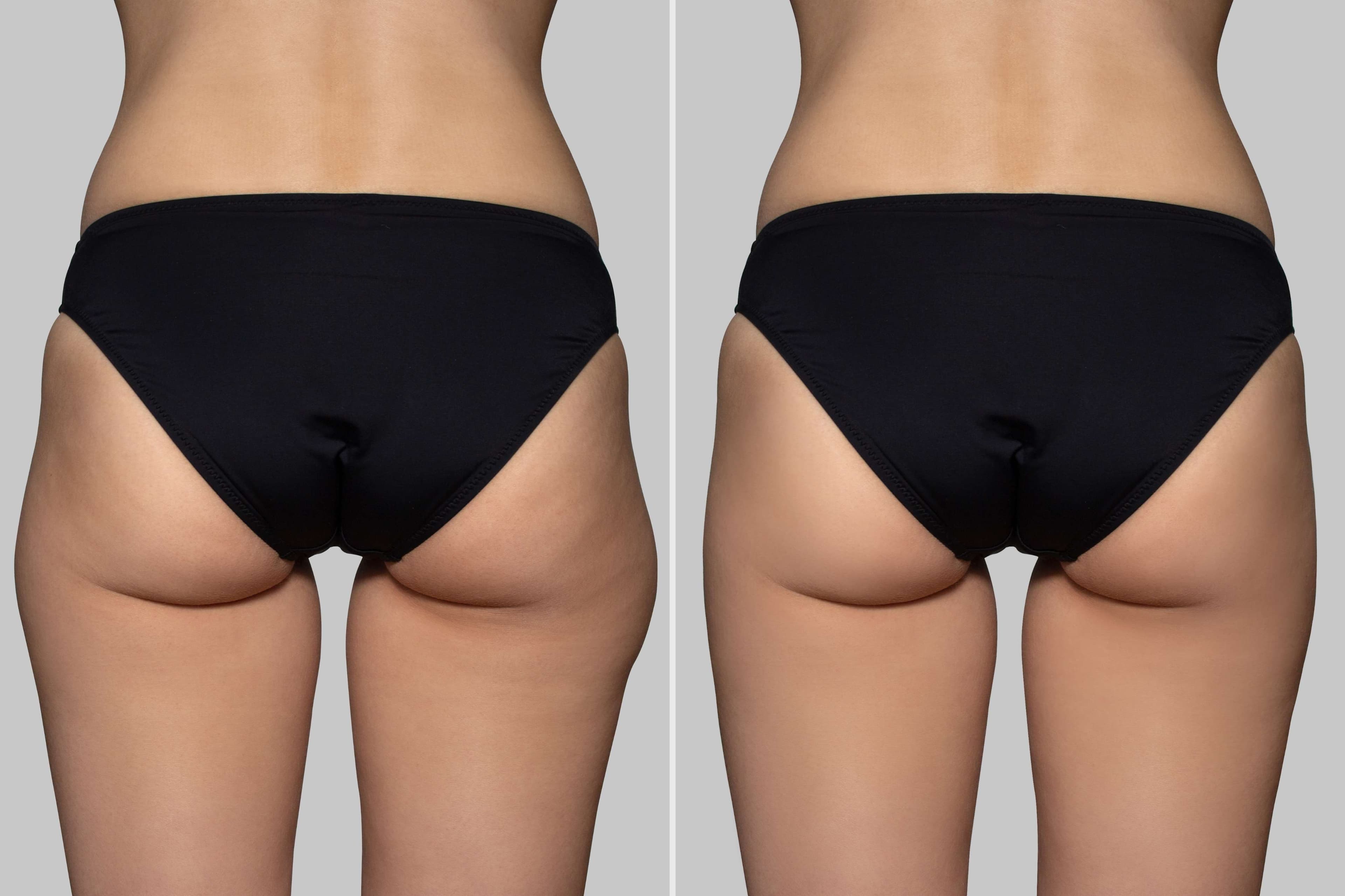 Hip Enhancement before and after result