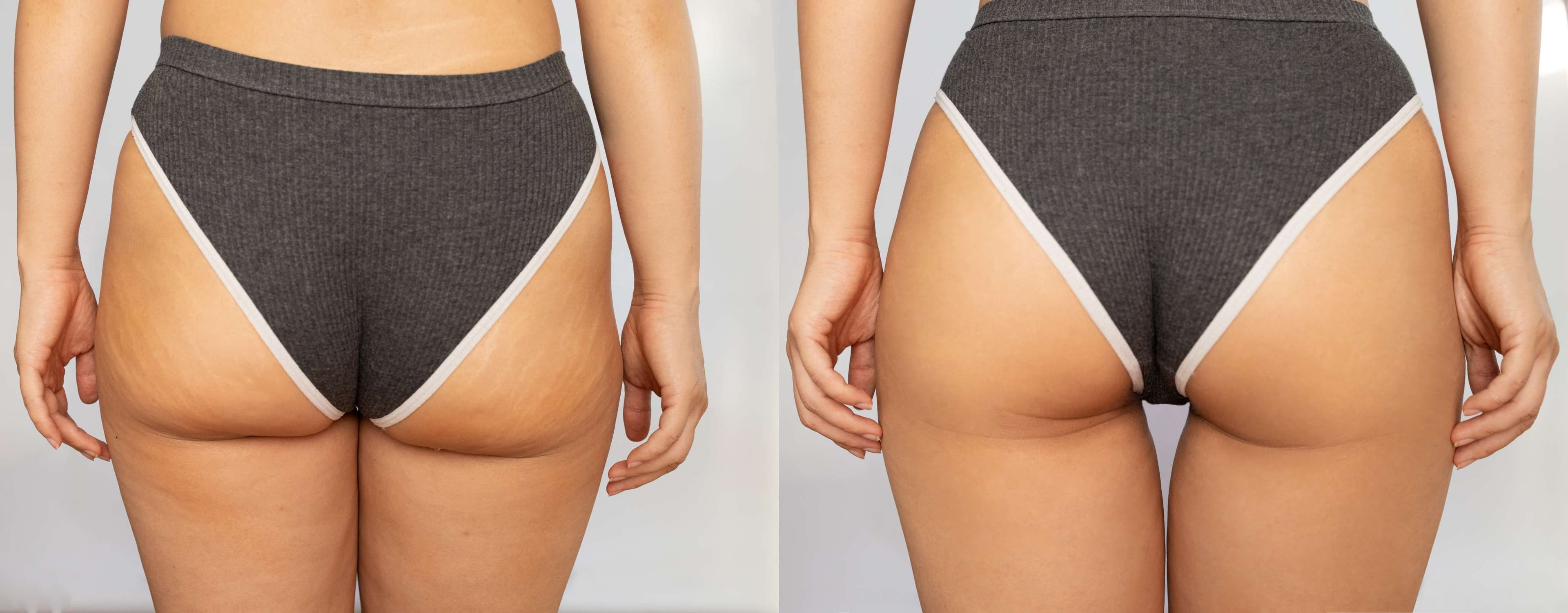 Hip Enhancement Injectable before and after result