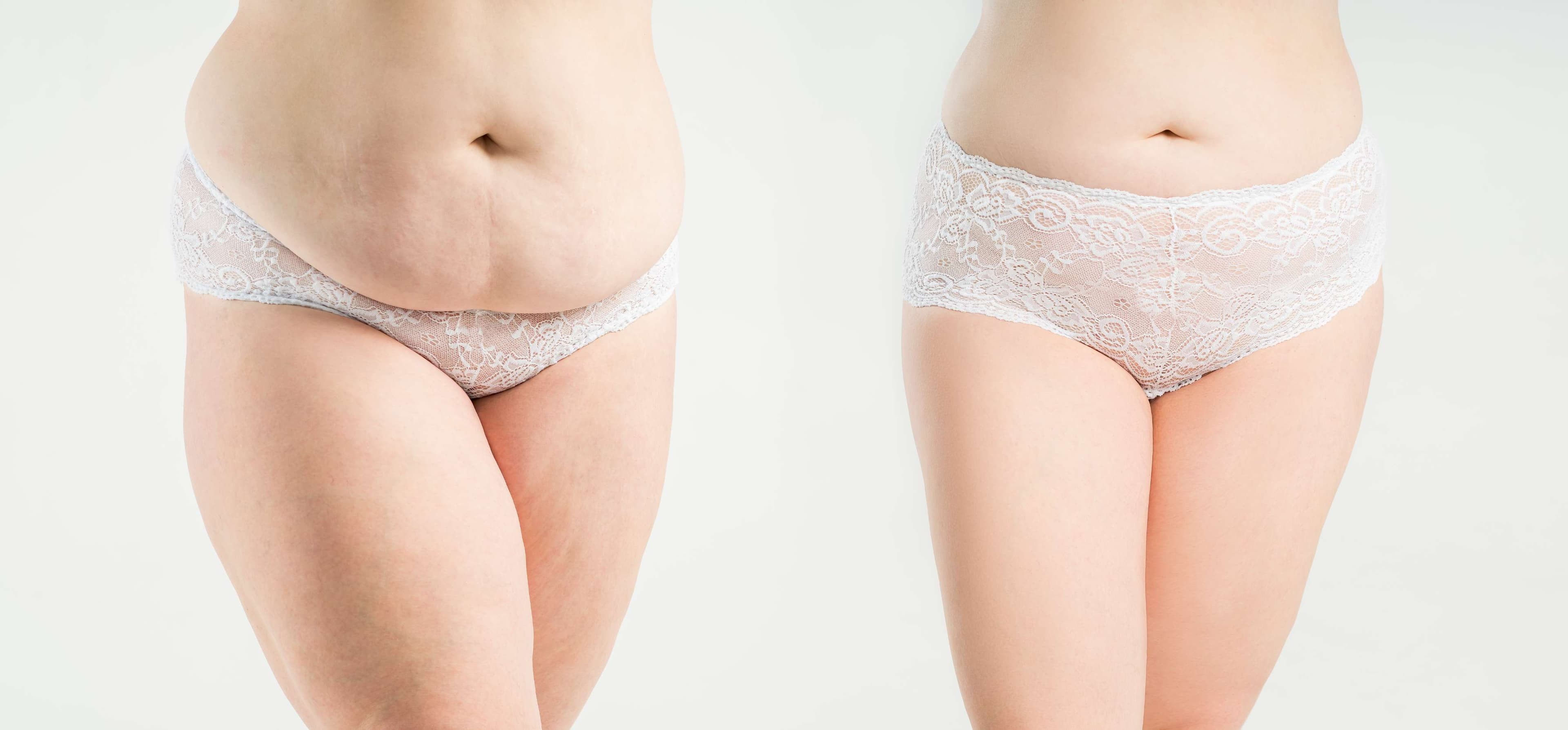 Abdominoplasty (Tummy Tuck) before and after result