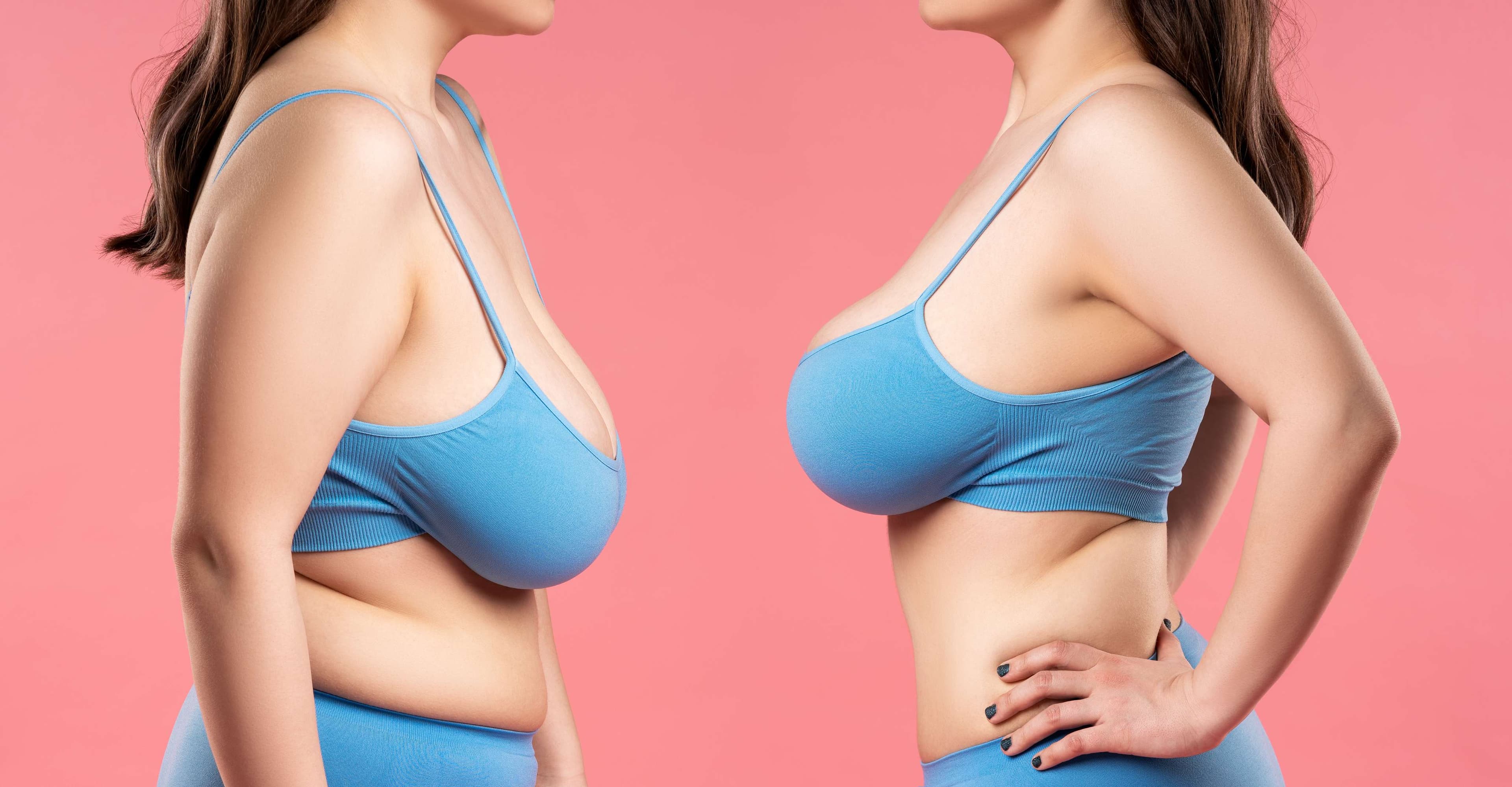 Breast Lift (Mastopexy / Maxopexy) before and after result