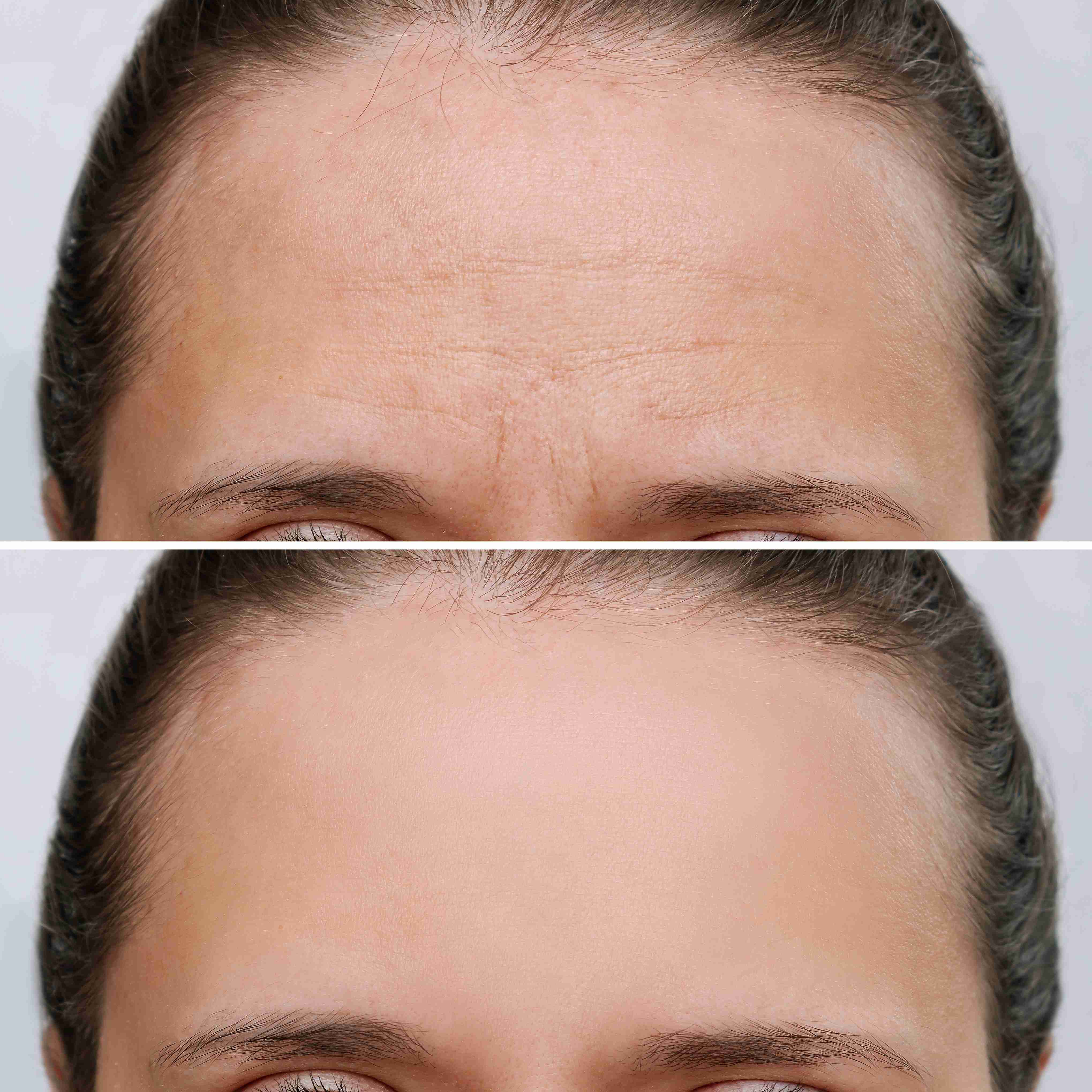 Brow Lift (Forehead Lift) before and after result