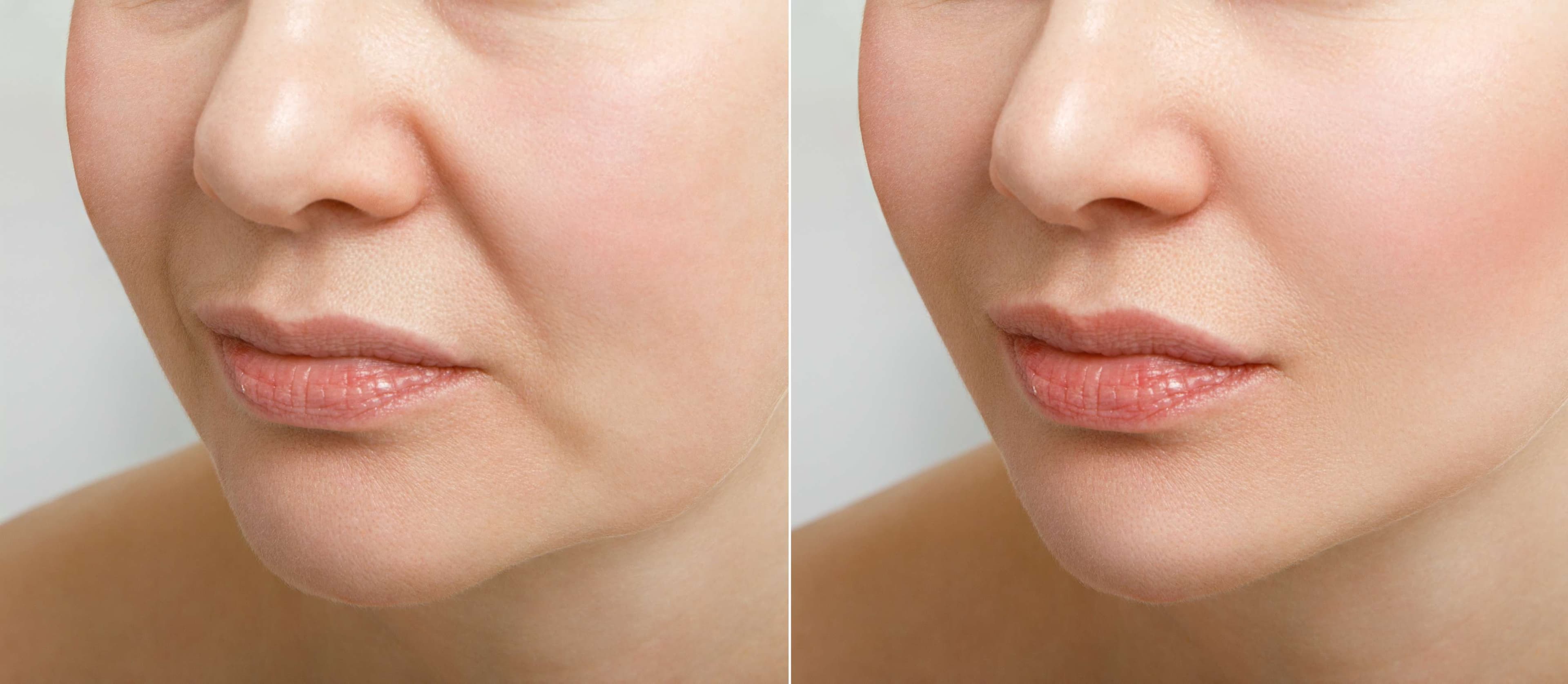 Cheek Enhancement before and after result