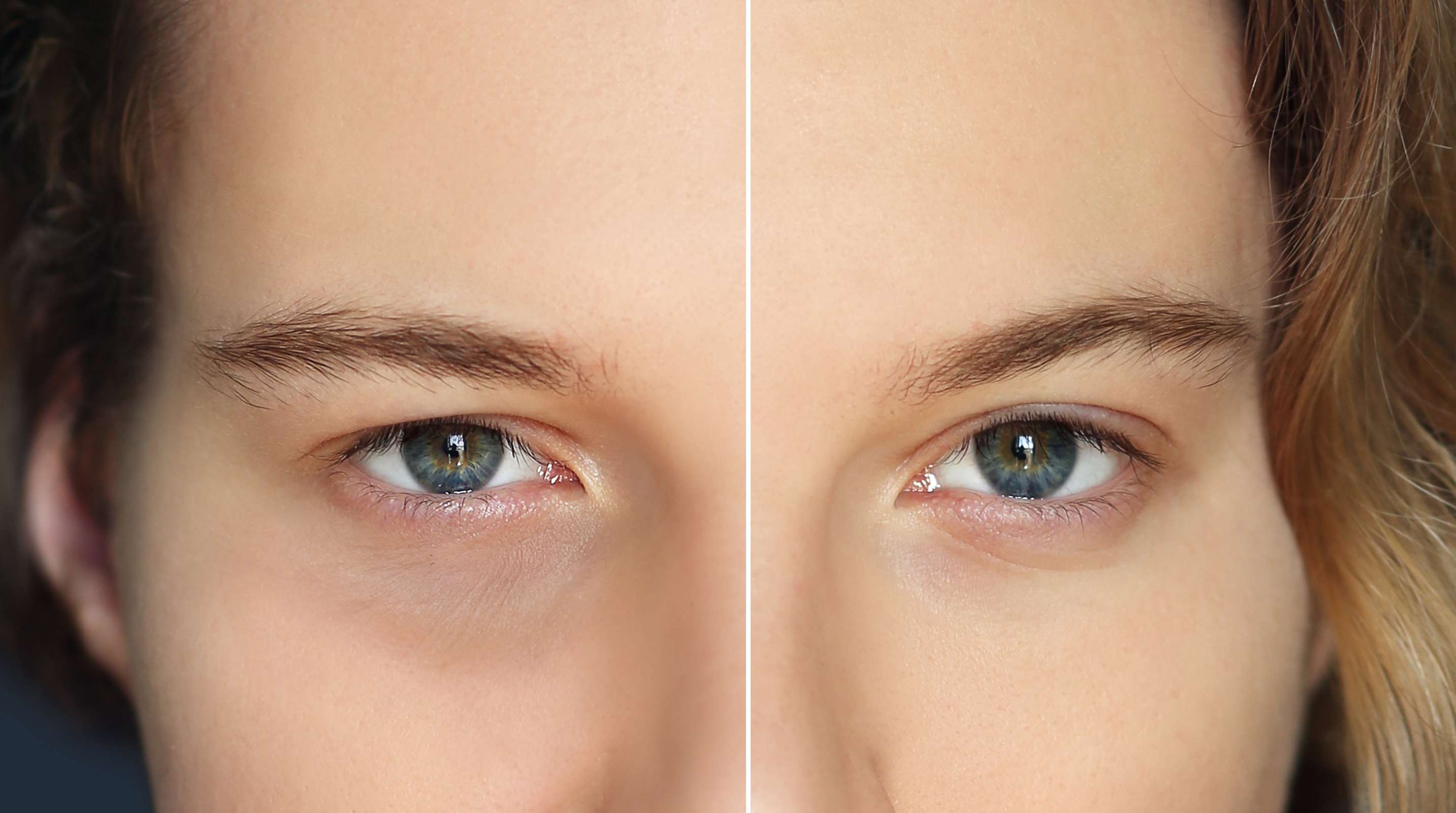 Blepharoplasty (Eyelid Surgery) before and after result