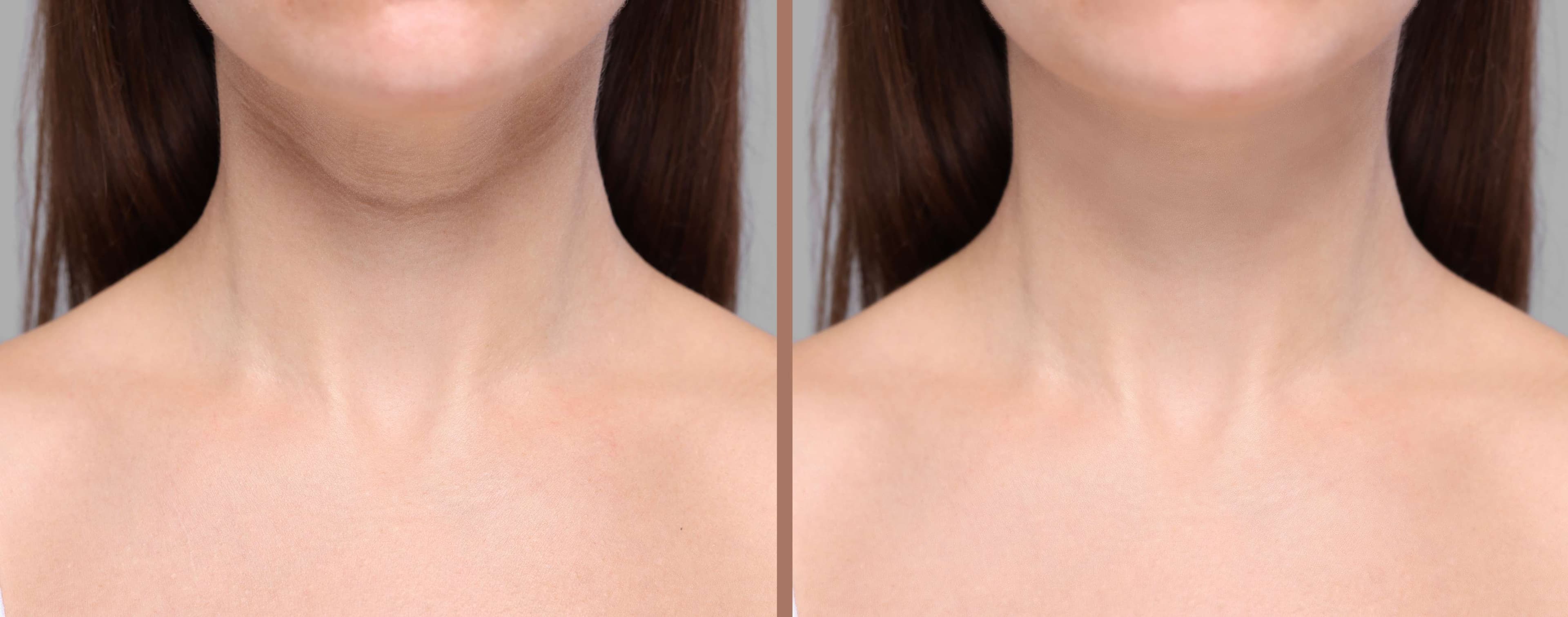 Neck Lift before and after result