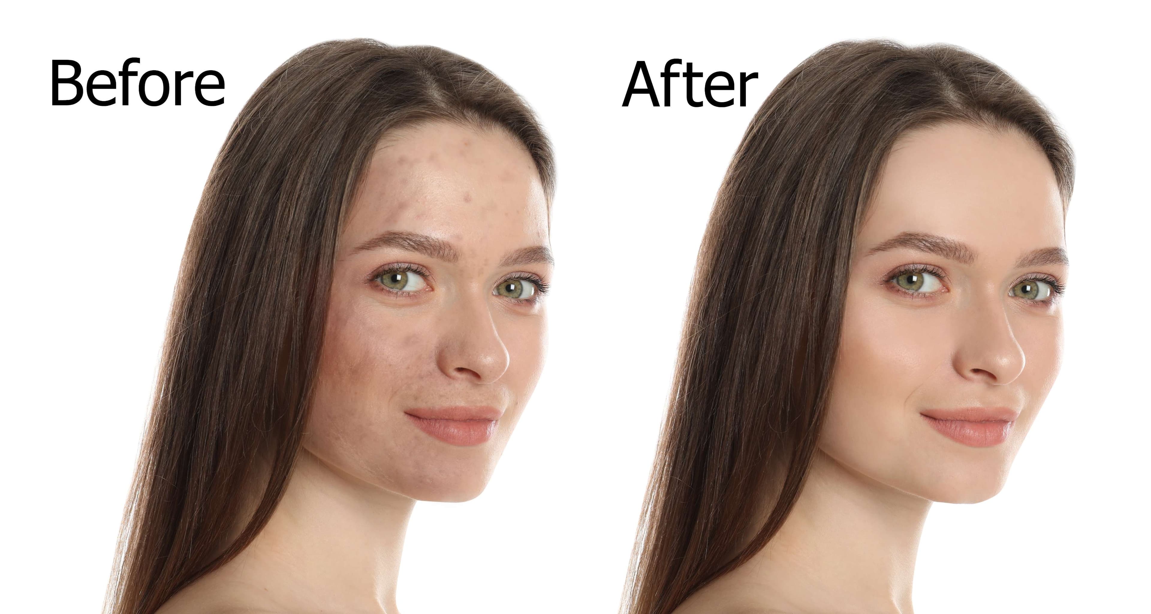 Chemical Peels before and after result