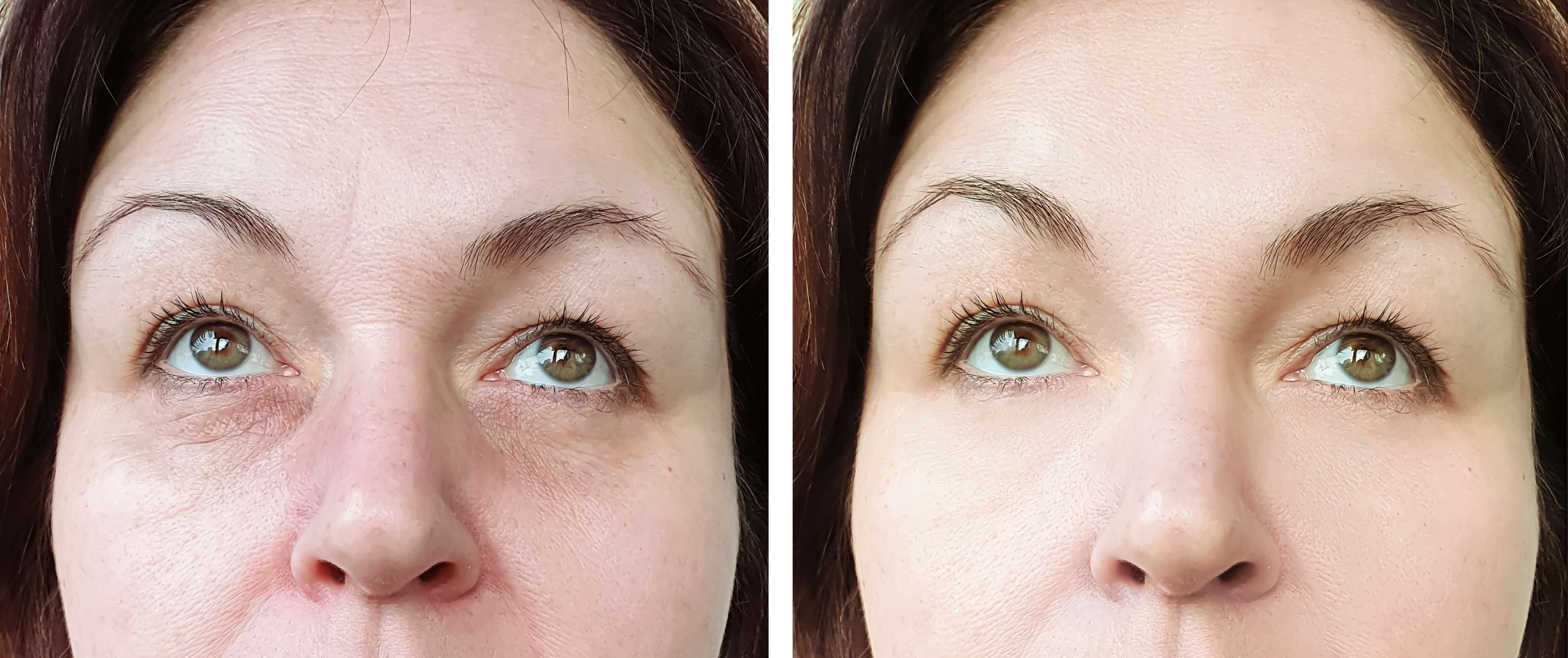 Face Radiofrequency Treatments before and after result