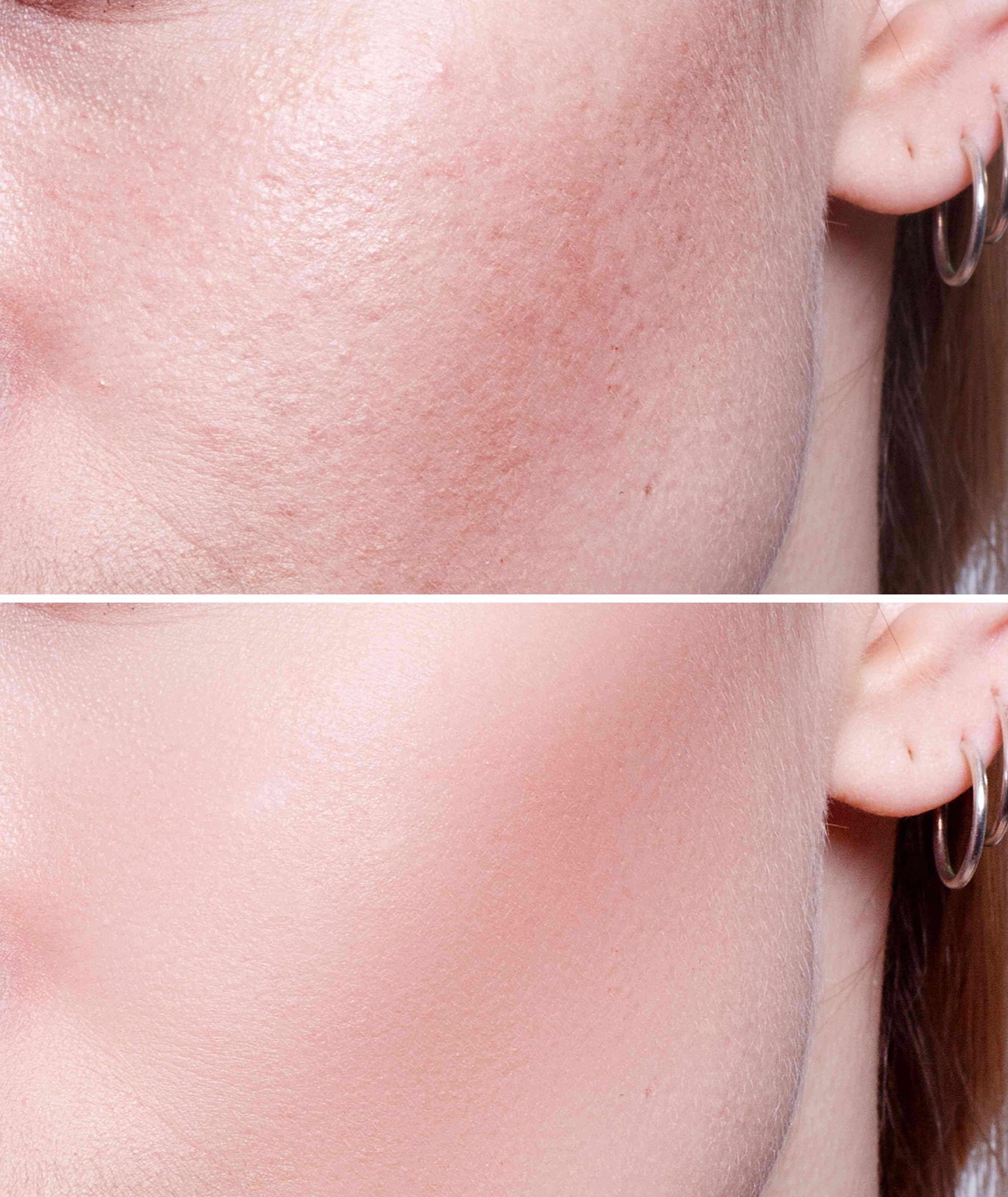 Vampire Facial / PRP Facial before and after result