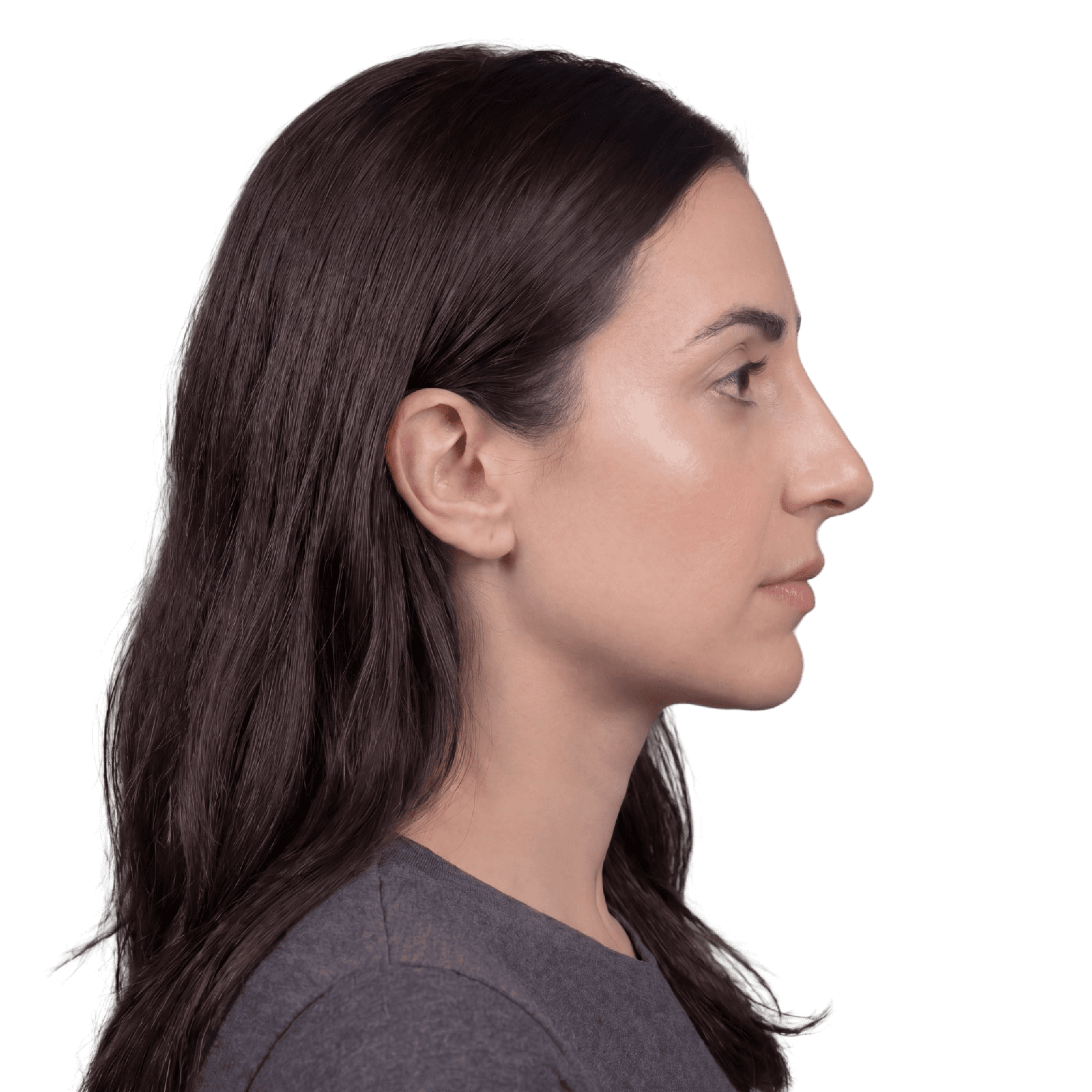 Rhinoplasty after