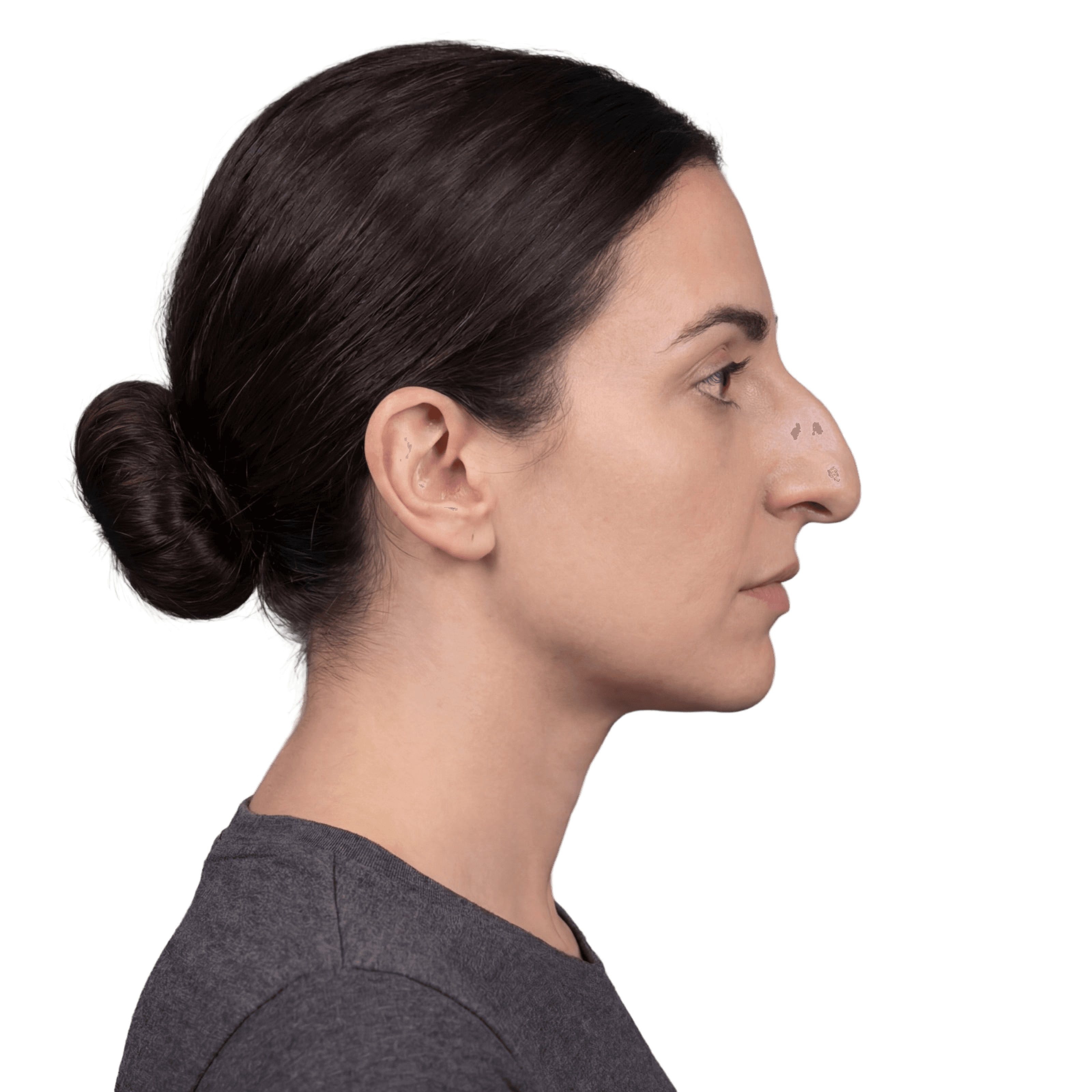 Rhinoplasty before