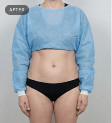 Tummy Tuck after