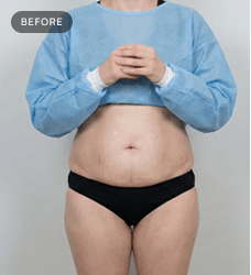 Tummy Tuck before