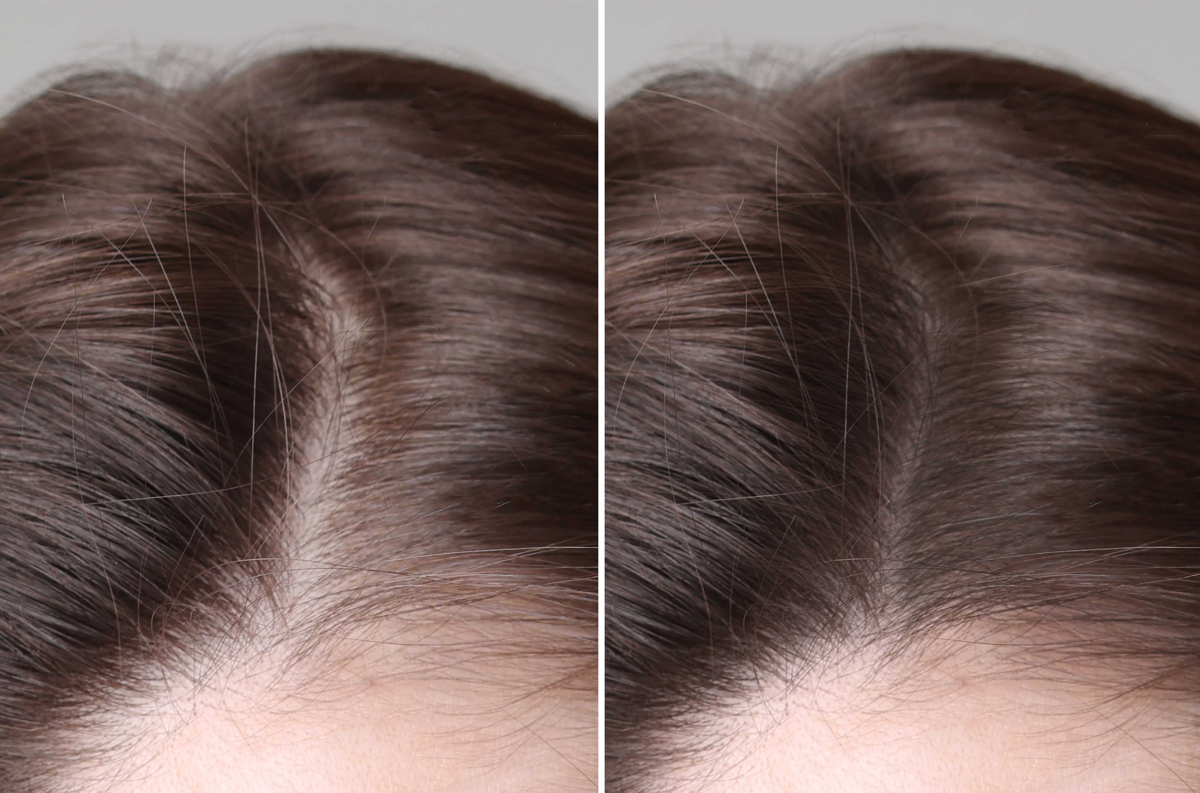 PRP Therapy for Hair before and after result