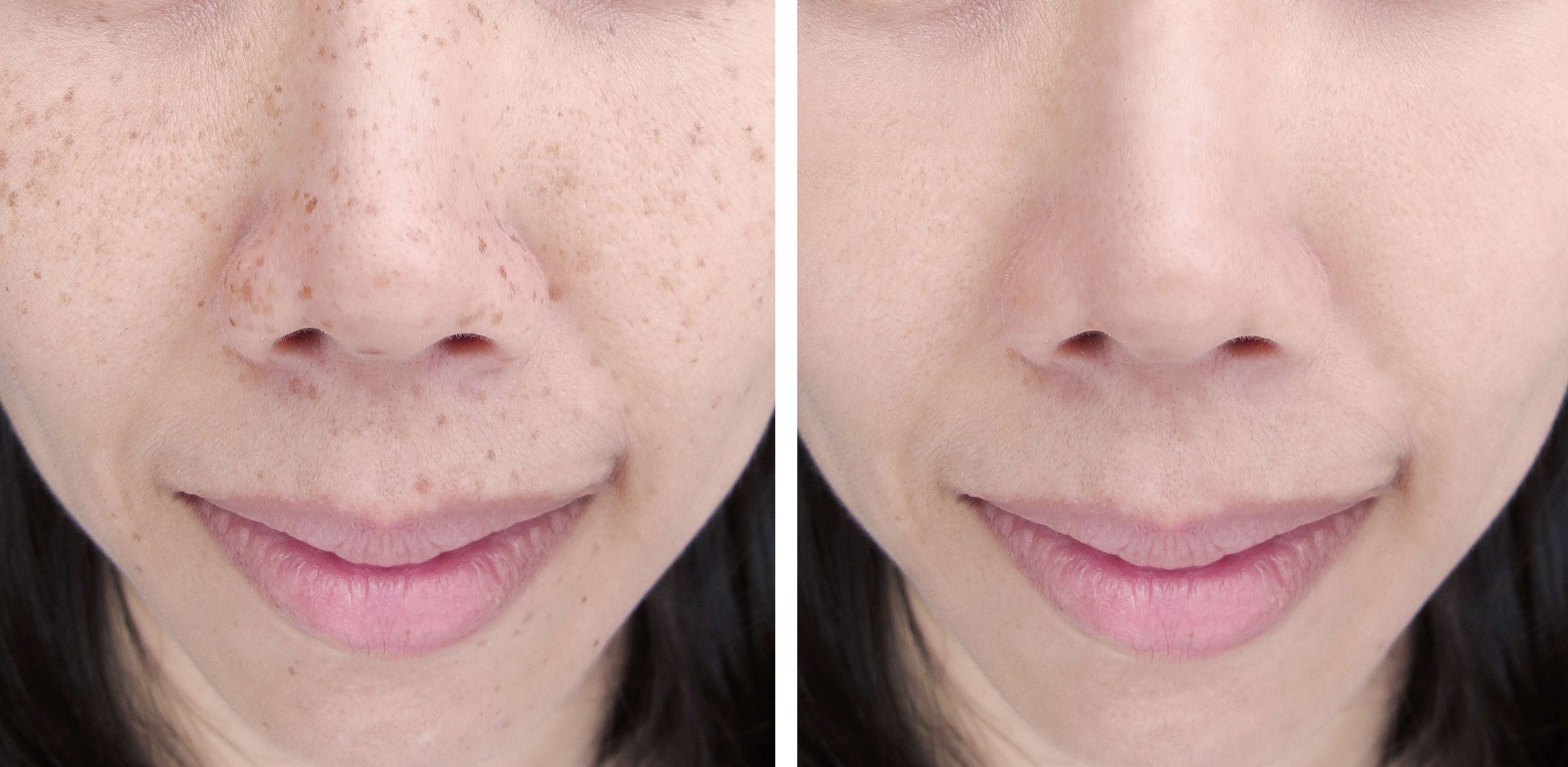 Laser Treatments before and after result