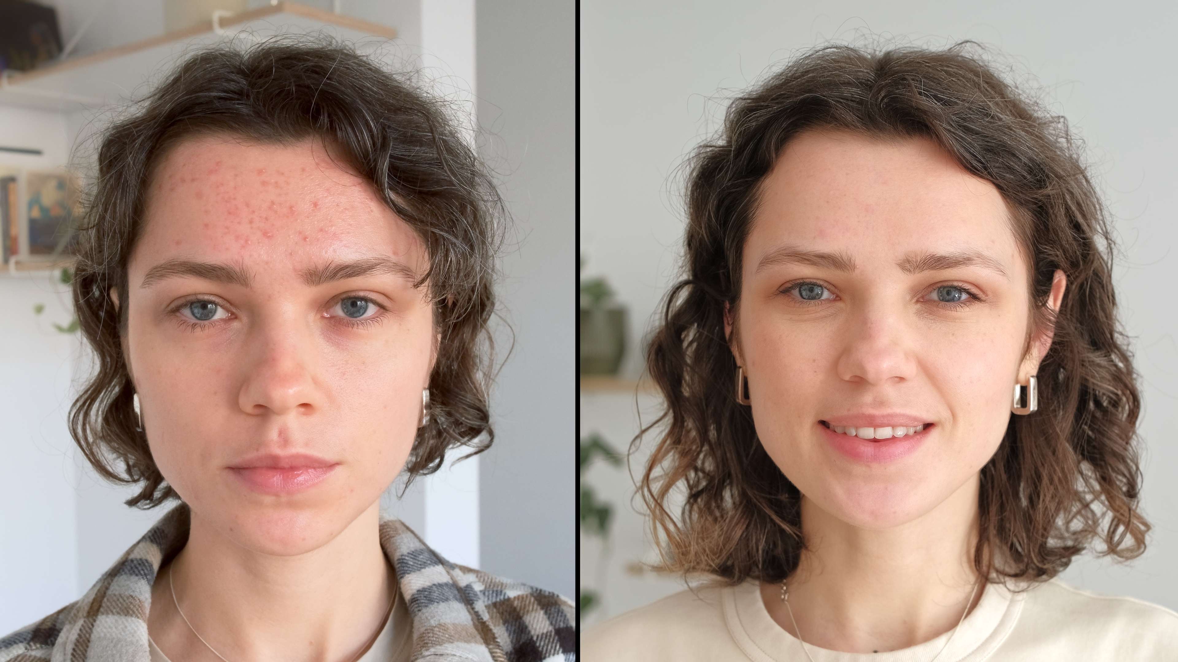 Microneedling (Collagen Induction Therapy) before and after result