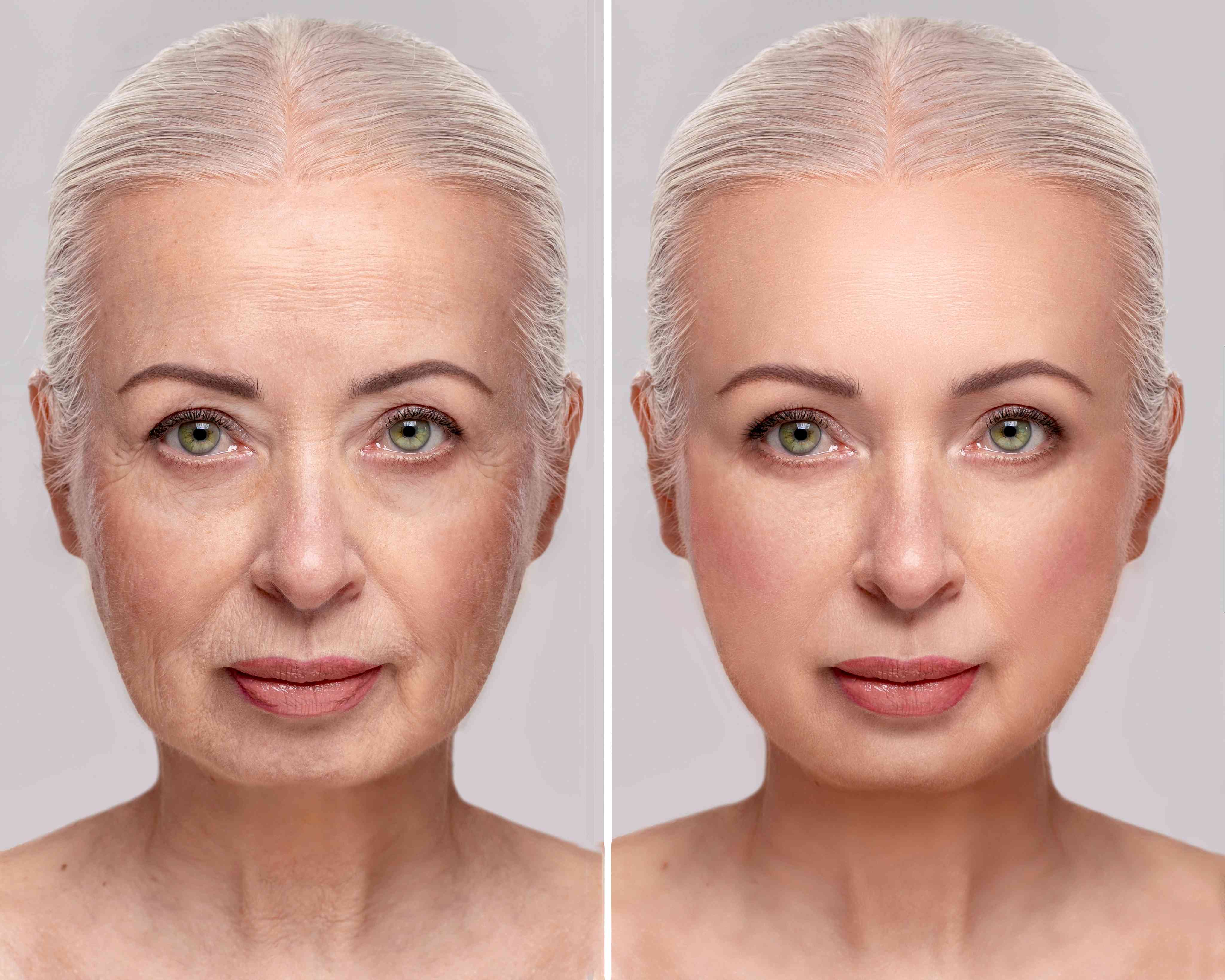 Skin Tightening / Ultherapy before and after result