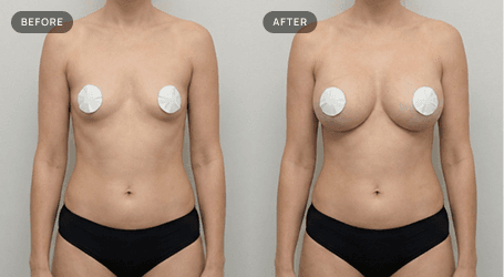 Breast Aug. before and after