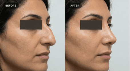 Rhinoplasty before and after